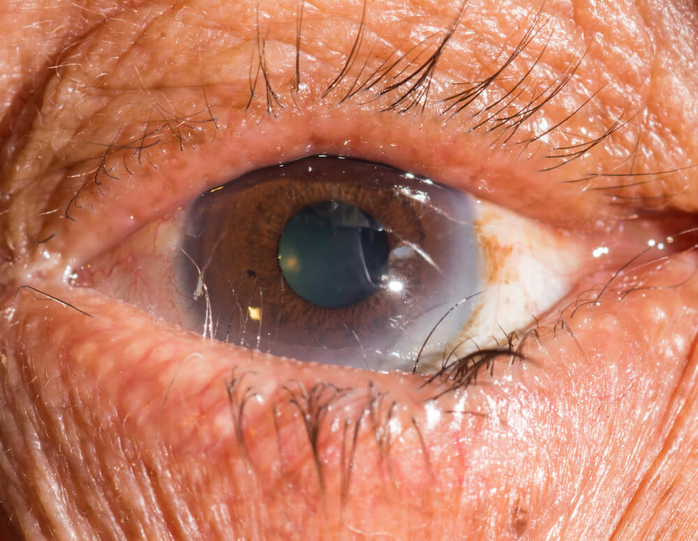 Chybný růst řas (trichiáza)